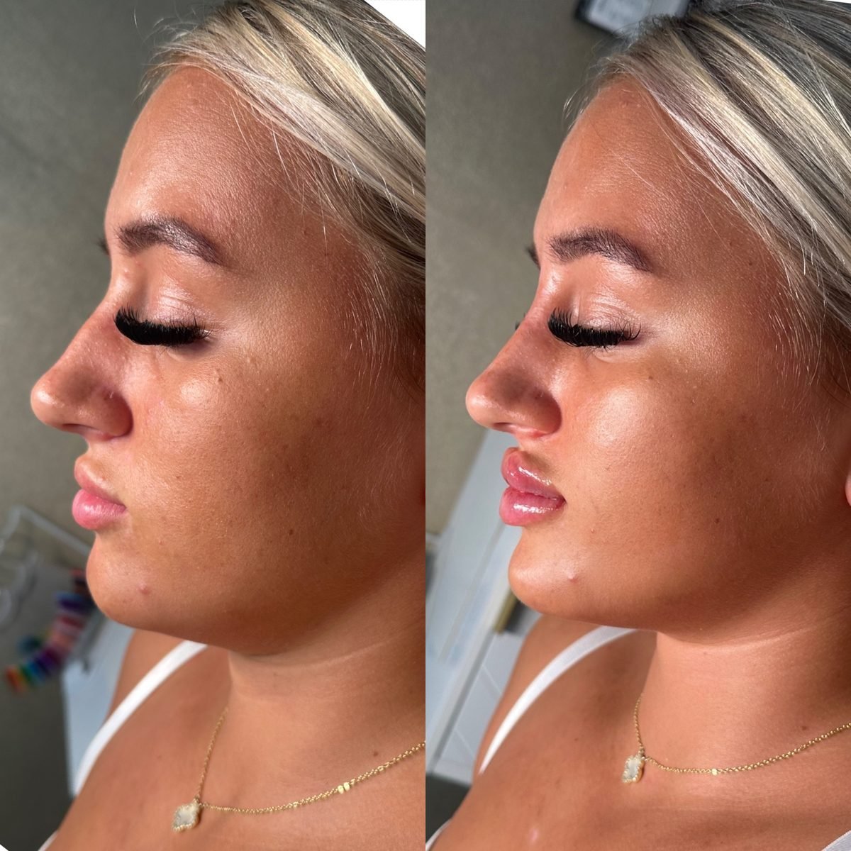 Profile Balancing result at BKM Aesthetics